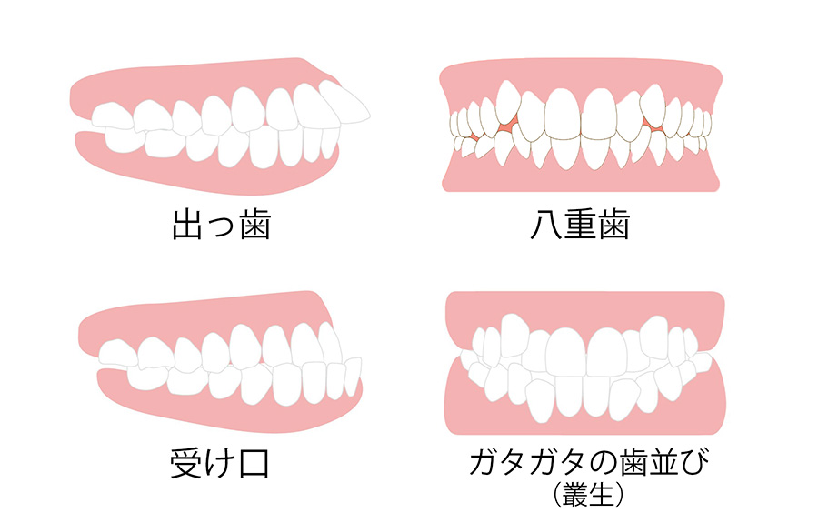 歯並びのイメージ画像「出っ歯（口ゴボ）、受け口、八重歯」