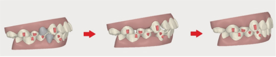 インビザライン小臼歯を抜歯する場合のイメージ