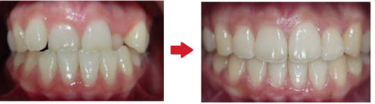 インビザライン治療例-正面