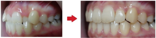 インビザライン治療例-側面