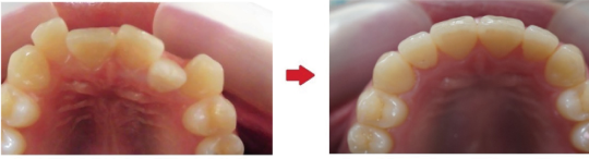 インビザライン治療例-咬合面