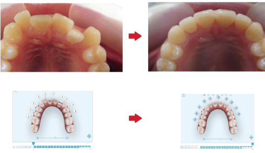 インビザラインの症例写真-咬合面