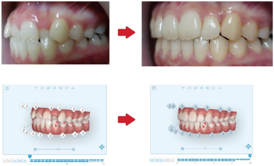 インビザラインの症例写真-側面