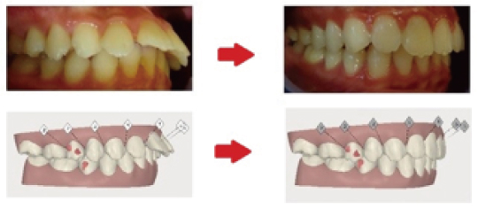 インビザラインの症例写真