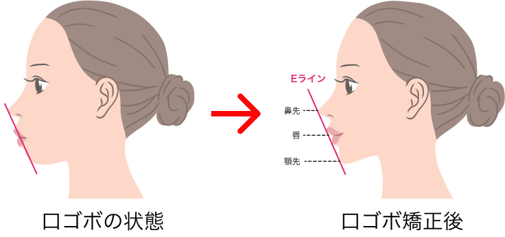 口ゴボ矯正（Eライン矯正）矯正前後のイメージ