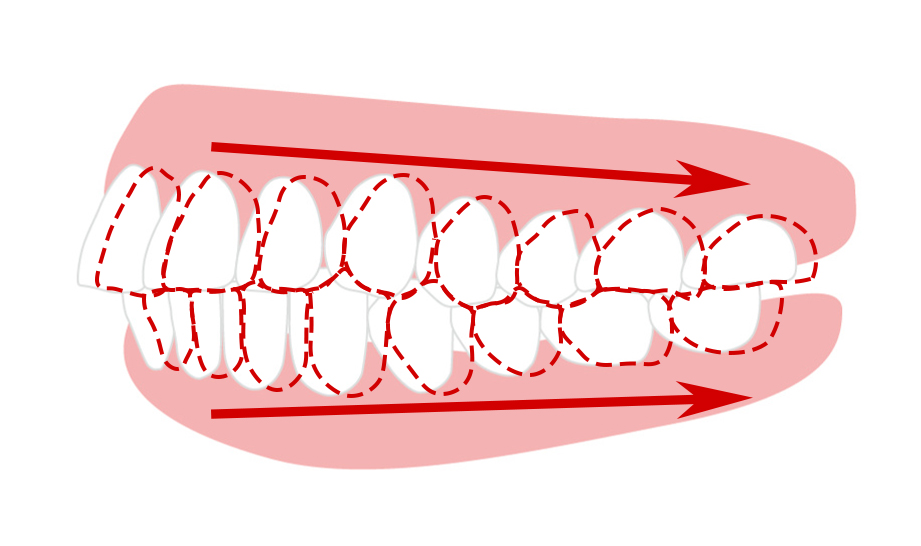 歯を後ろに動かす矯正法