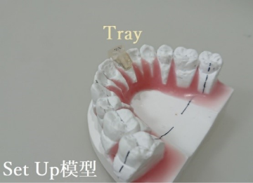 裏側の部分歯列矯正のセットアップ模型の写真