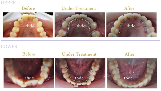 裏側ワイヤー矯正の症例写真（ビフォーアフター）